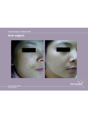 Acne treatment