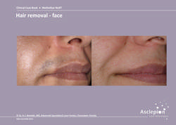 Hair removal