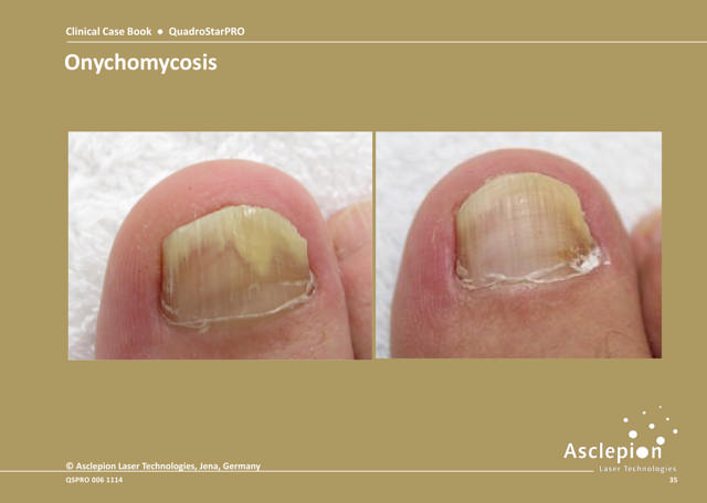 Nail treatment