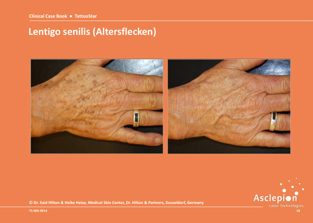Pigment removal