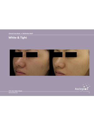Skin Whitening