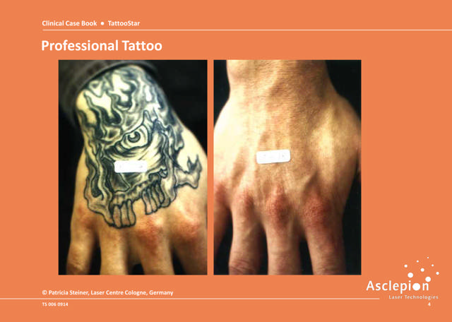 Tattoo removal
