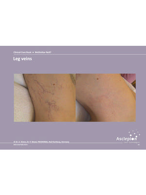 Vascular treatments