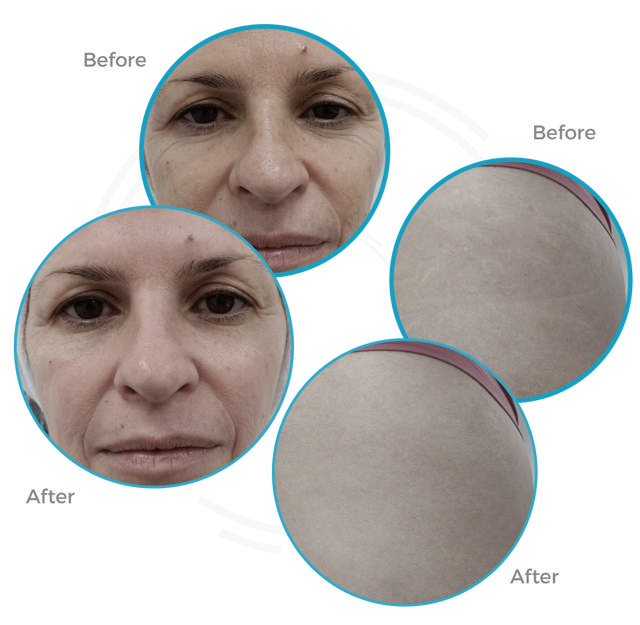 Musa CO2 Fractional Laser 